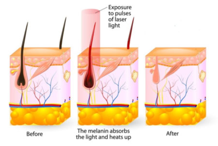 Laser hair removal
